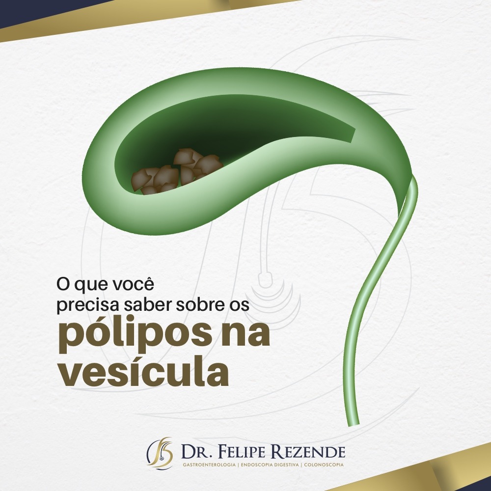 Ultrassonografia De Polipos Da Vesicula Biliar
